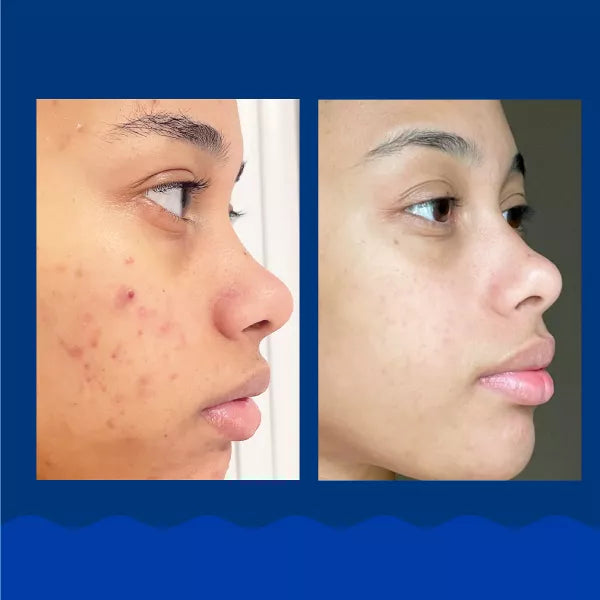 Panoxyl Acne Foaming Wash