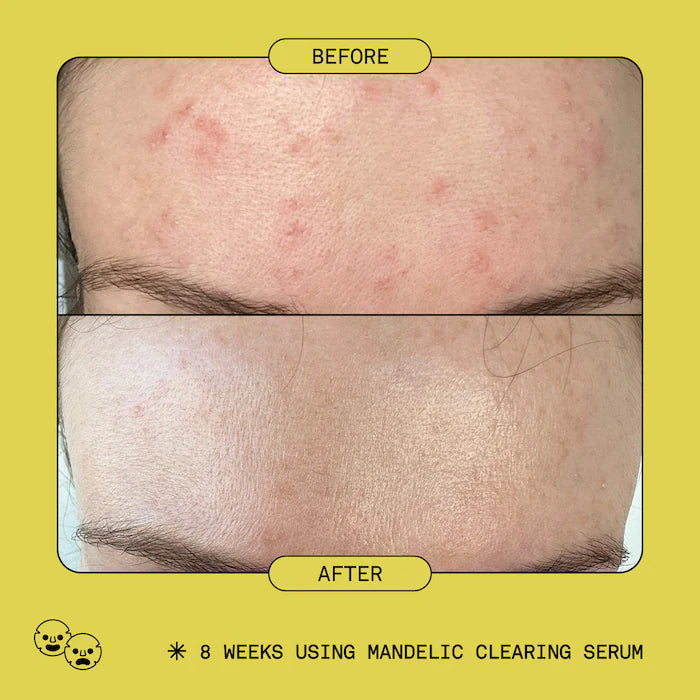 Mandelic Acid Exfoliating & Clearing Serum