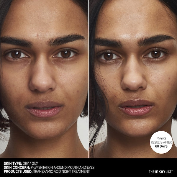 Tranexamic Acid Hyperpigmentation Treatment