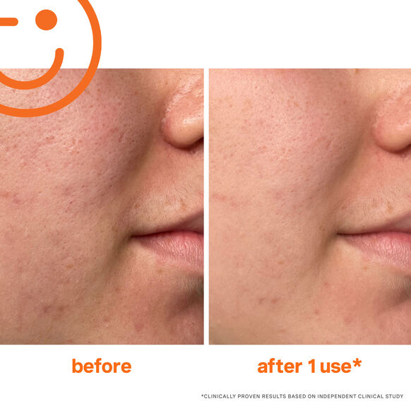 Exfolikate Intensive Exfoliating Treatment