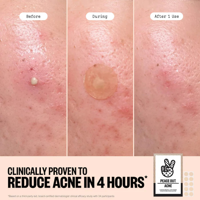 Salicylic Acid Acne Healing Dots