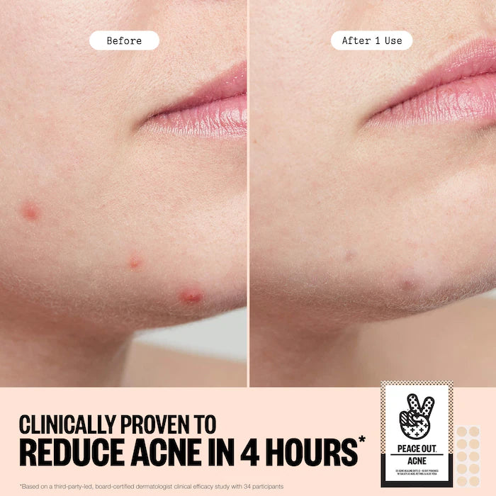 Salicylic Acid Acne Healing Dots