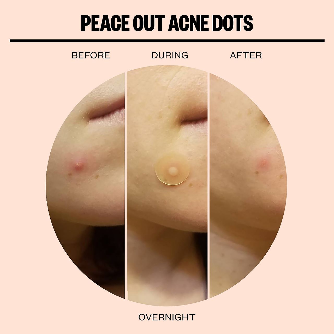 Salicylic Acid Acne Healing Dots